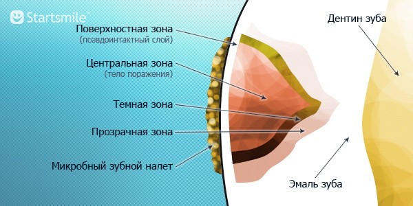Кариес зубов в картинках