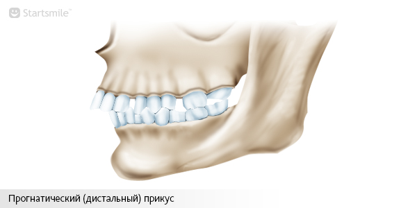 Прогнатический (дистальный) прикус