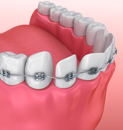 Лечение клиновидного дефекта зубов в москве thumbnail