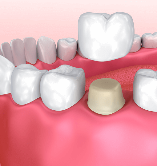 Сколько стоит лечение кариеса переднего зуба thumbnail