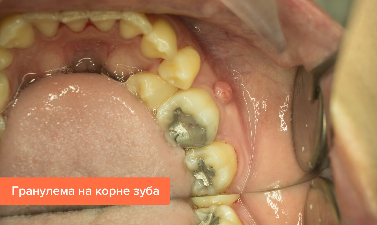 Лечение гранулемы при перфорации канала зуба thumbnail