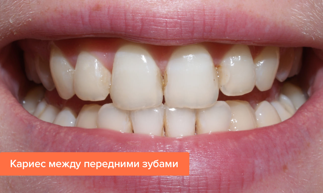 Лечение кариеса между зубами thumbnail