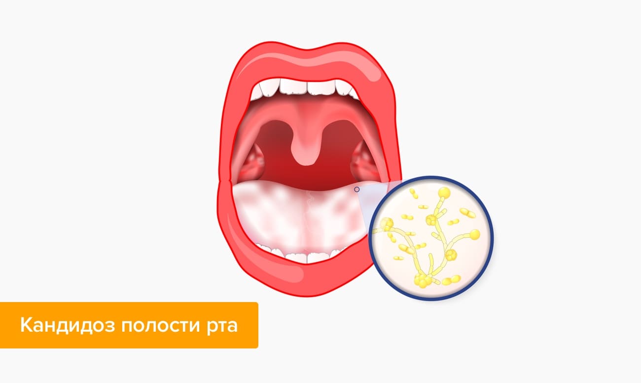 Как вылечить молочницу рта у взрослого народными средствами thumbnail