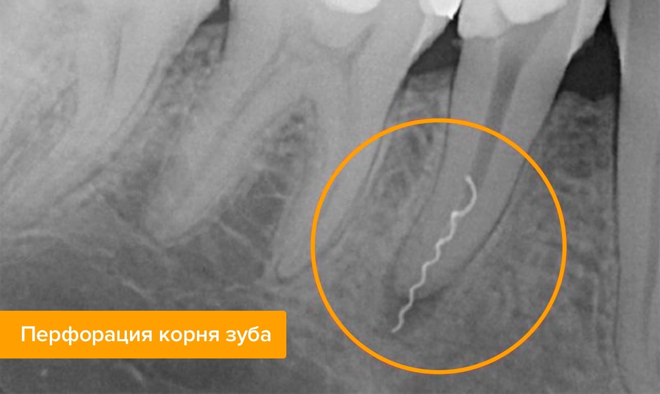 Почему болит зуб после лечения нерв удалили thumbnail