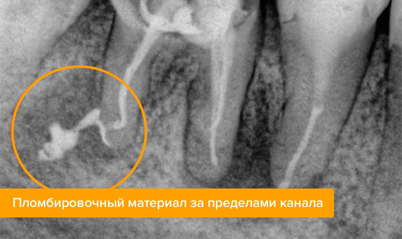 После лечения кариеса удалили нерв но зуб болит thumbnail