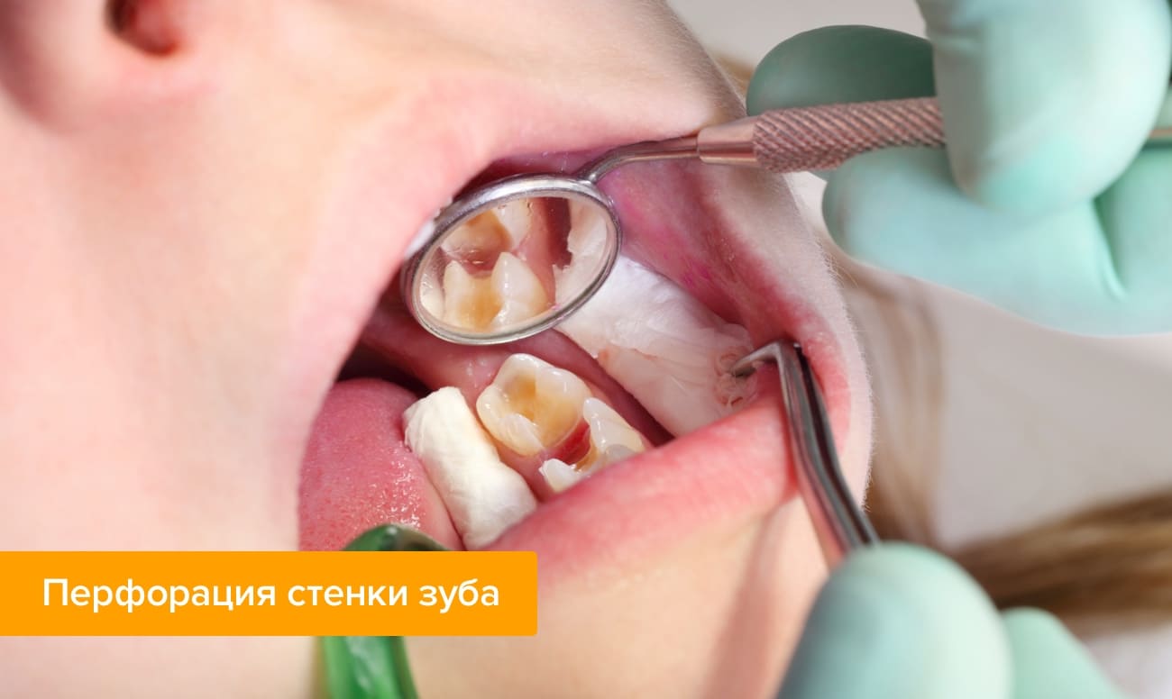 Фото перфорации стенки зуба во рту у пациента 