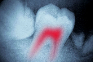 Каналы при лечении зубов thumbnail