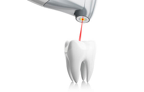 Что такое лечение зубов лазером thumbnail