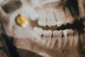 Зубы у ребенка в 2 года график thumbnail