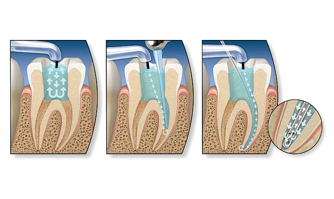 Лечение зубов методом ампутации пульпы thumbnail