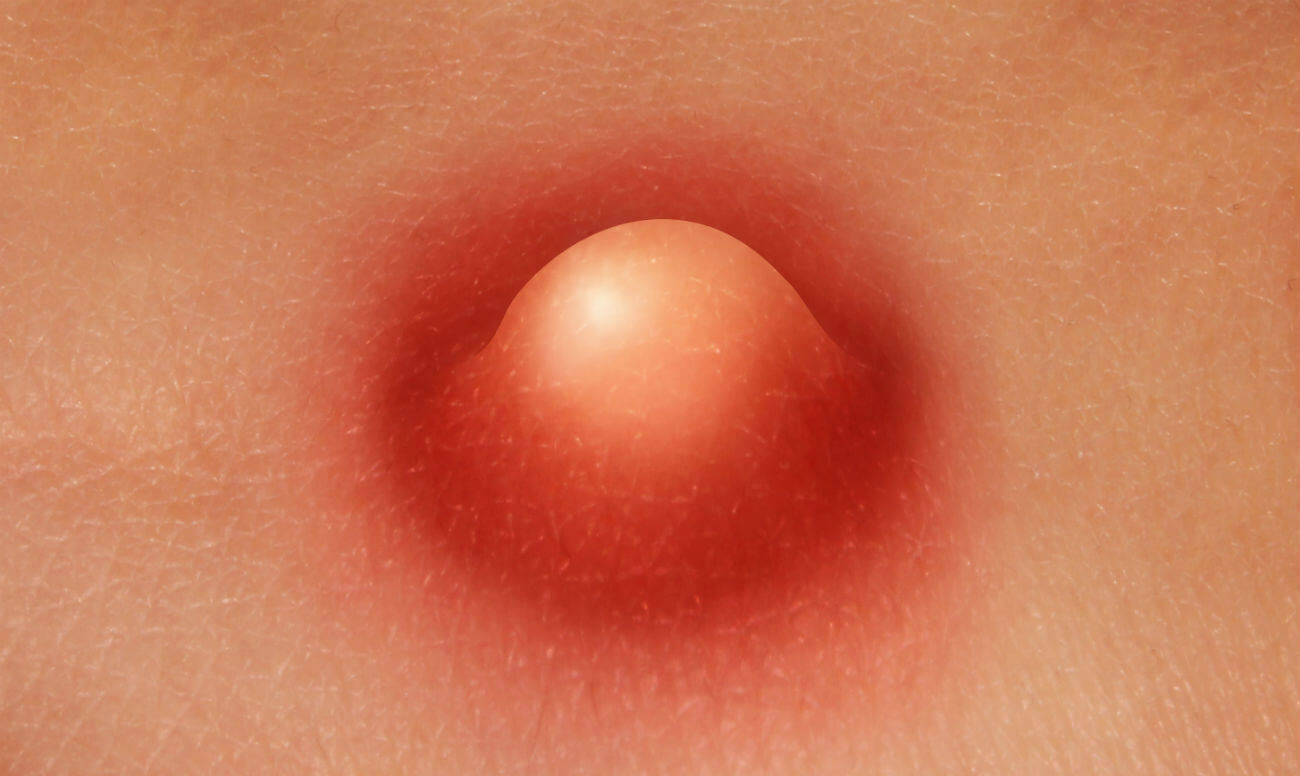 фурункул на груди у женщин лечение фото 106