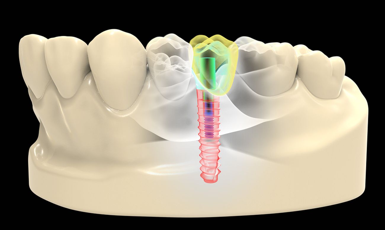 Отторжение имплантата зуба