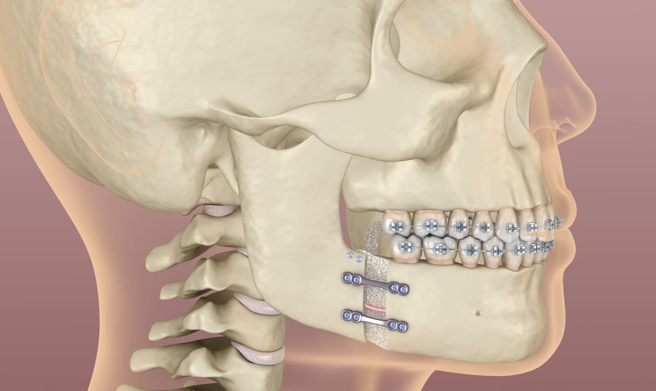 Исправление прикуса хирургическим путем фото