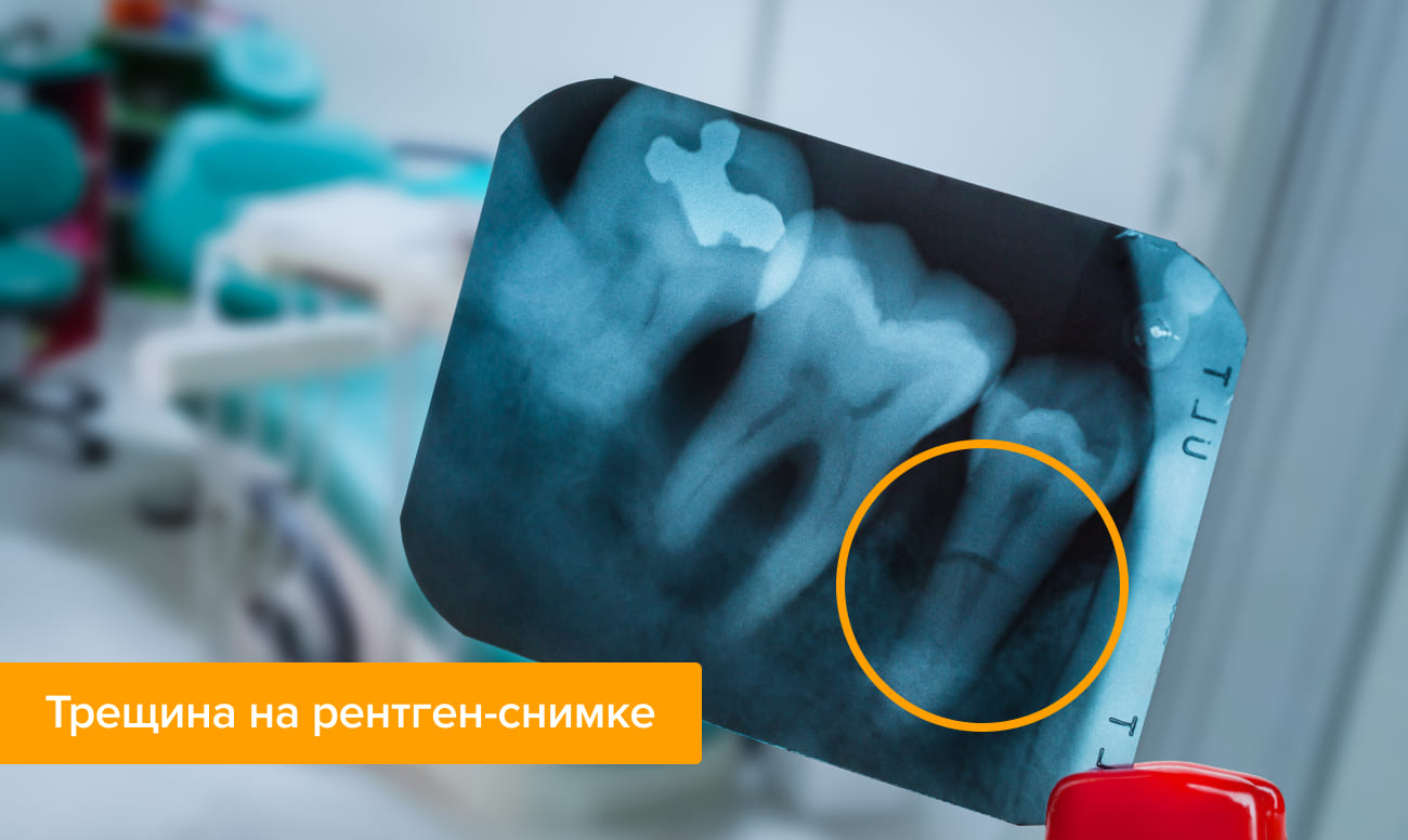 На зубах появились трещины – причины, лечение и профилактика