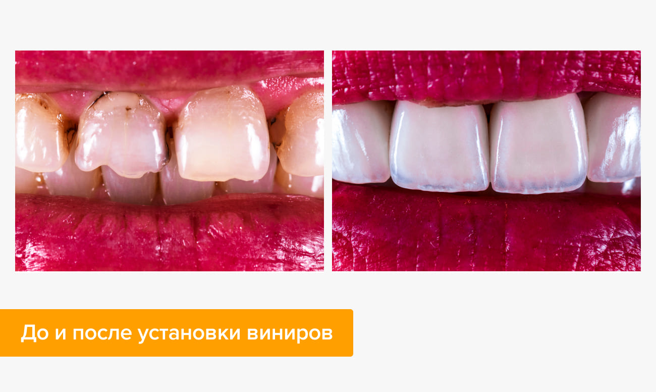 Как устанавливают виниры на зубы пошаговая инструкция с фото