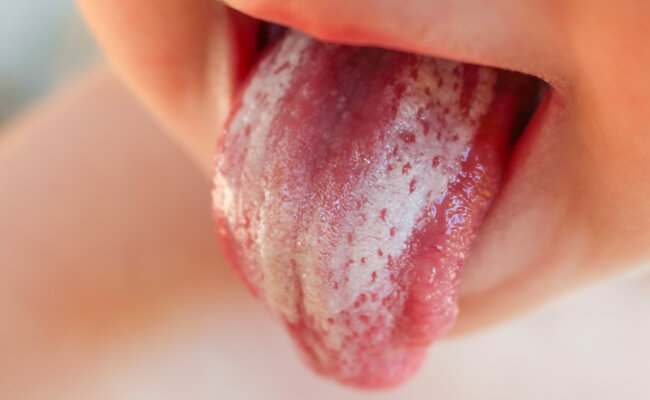 Характерные симптомы глоссита языка