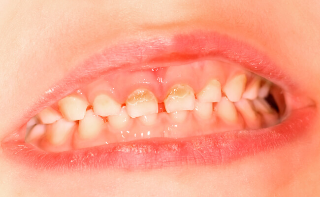 На передних молочных зубах кариес фото