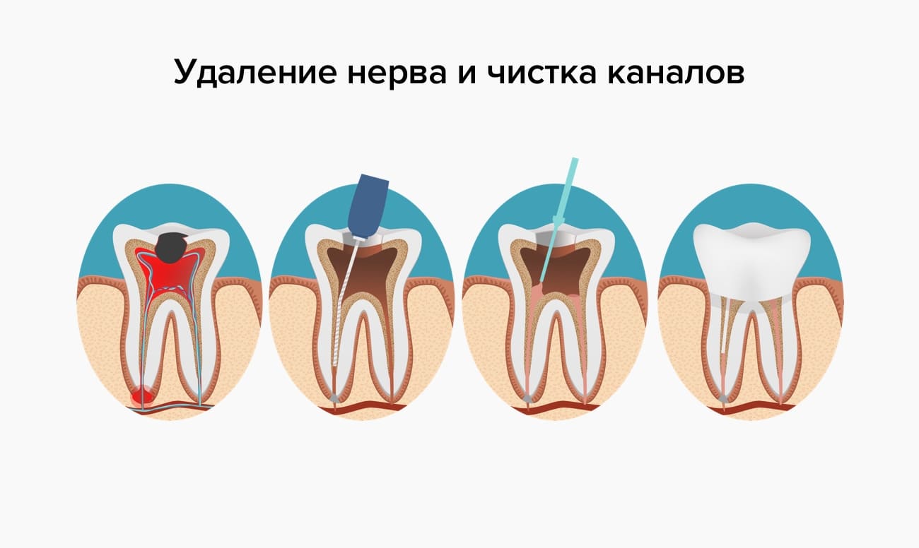 Боли после удаления нерва зуба