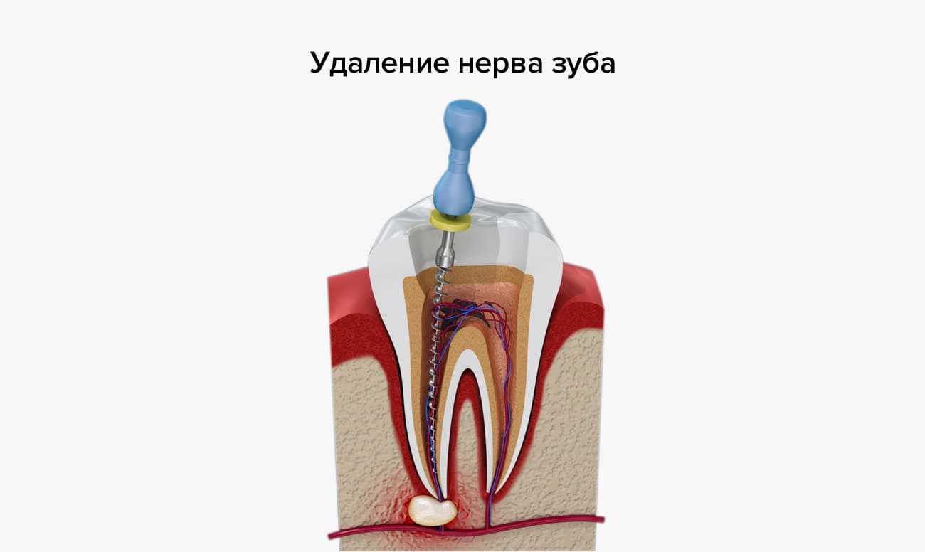 Почему мертвый зуб болит при надавливании: Причины боли в зубе с удаленным нервом