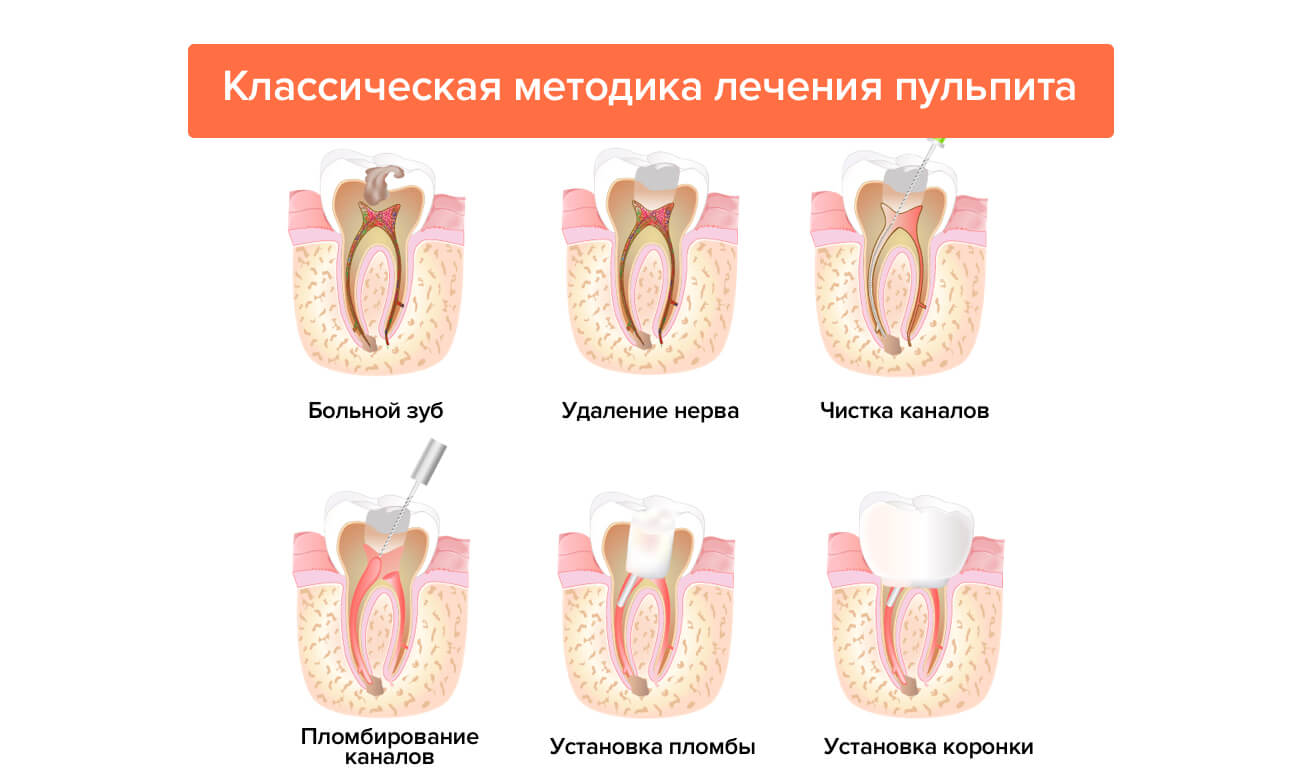 Виды удаления. Методы лечения воспаления пульпы зуба.