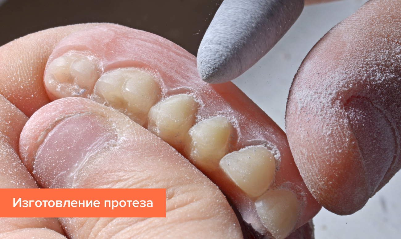 «Чем склеить зубной протез в домашних условиях?» — Яндекс Кью