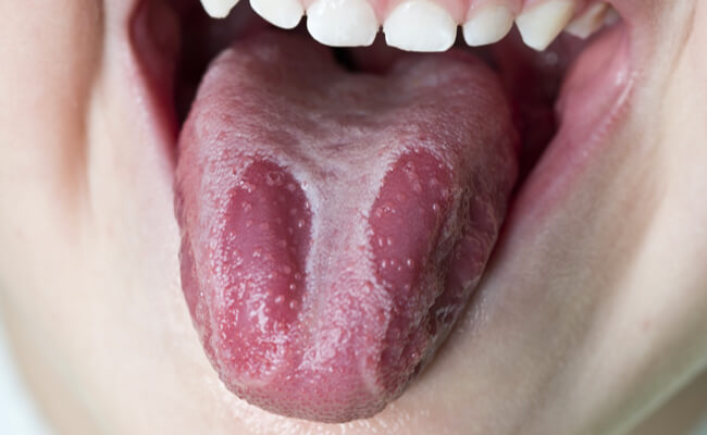 Глоссит языка: симптомы, причины, фото, почему появляются болячки на языке?