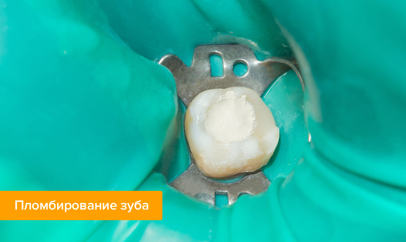 Болит зуб под пломбой — почему | Стоматология «Денталюкс-М» (Москва)
