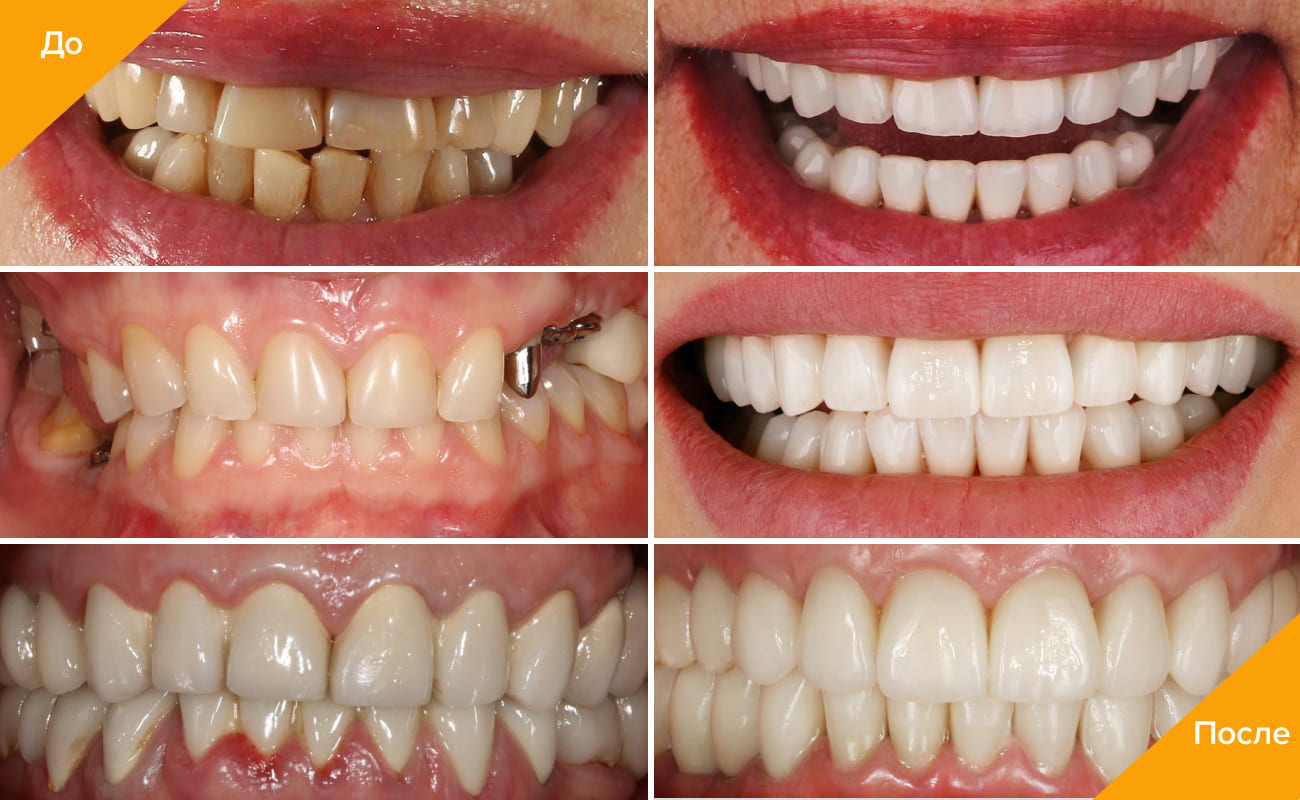 Зубные Коронки - Какие Виды Лучше Поставить?