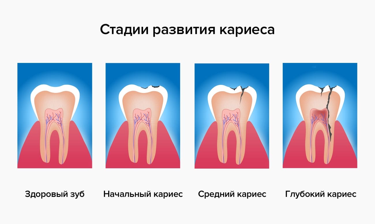 Флюс или абсцесс зуба: что это такое, методы лечения и профилактика