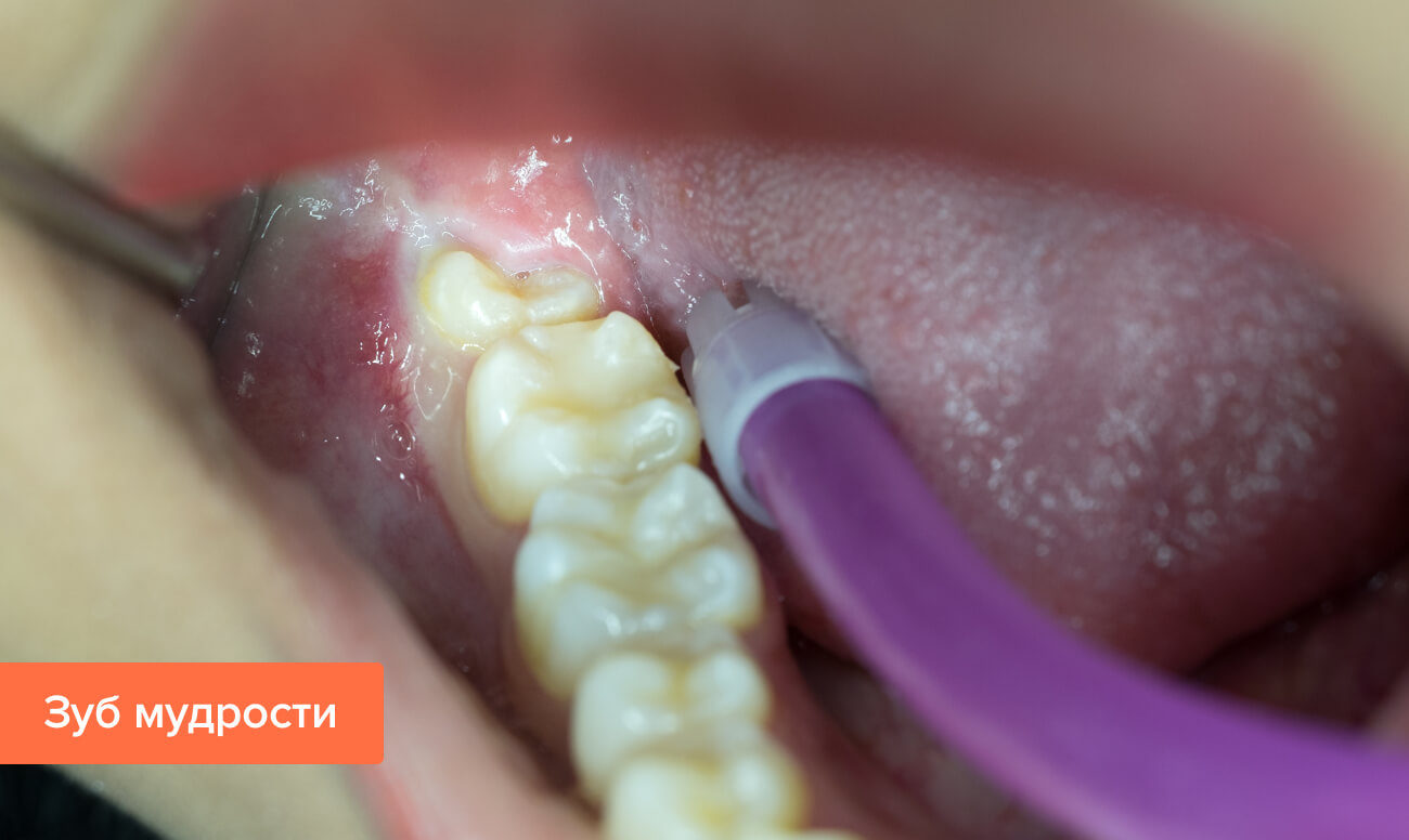 Гной после удаления зуба мудрости – почему так происходит и как лечить?