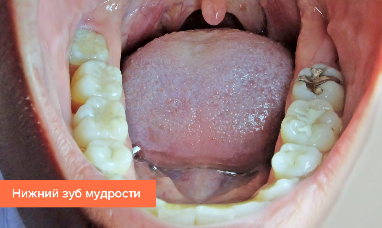 Дистопированный зуб мудрости – симптомы, удаление, фото, отзывы