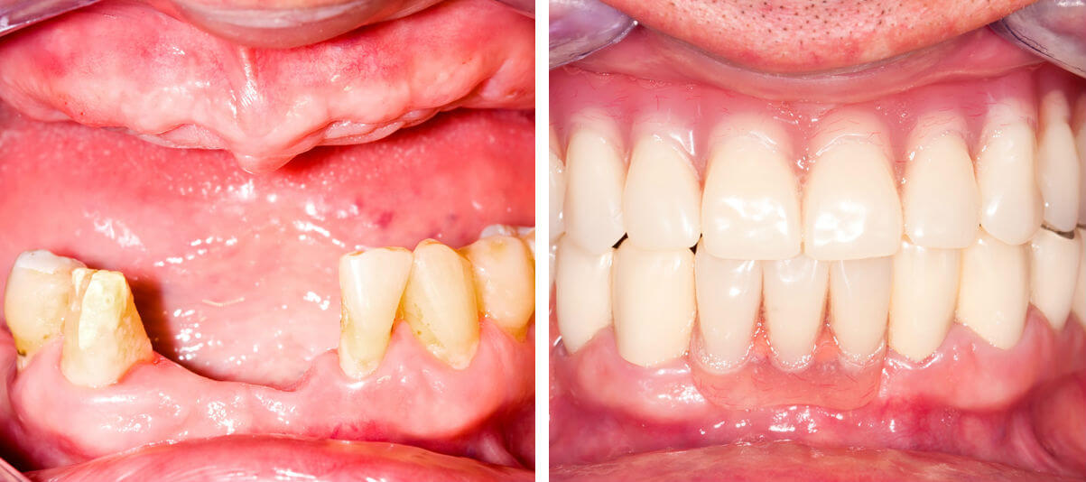 Зубы до и после протезирования фото