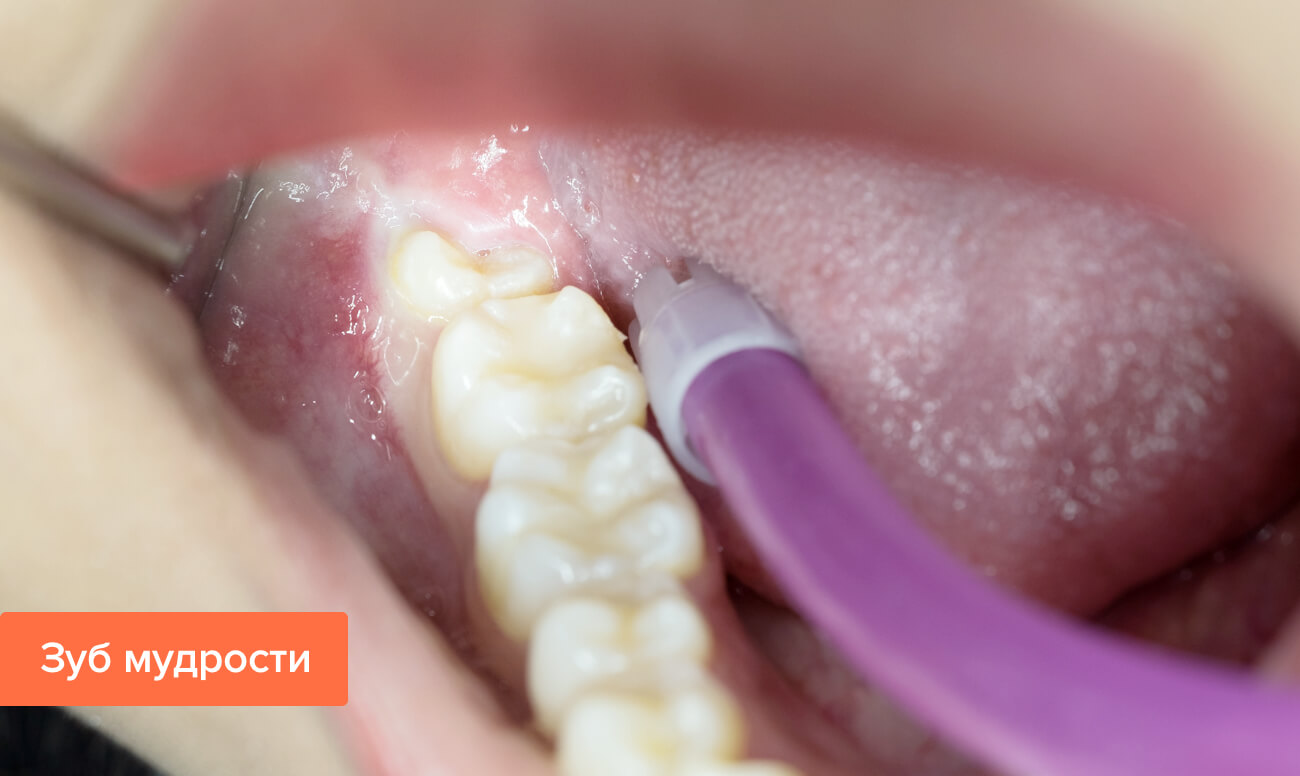 Удаление разрушенных зубов: почему нельзя оставлять корни, обломки зуба?