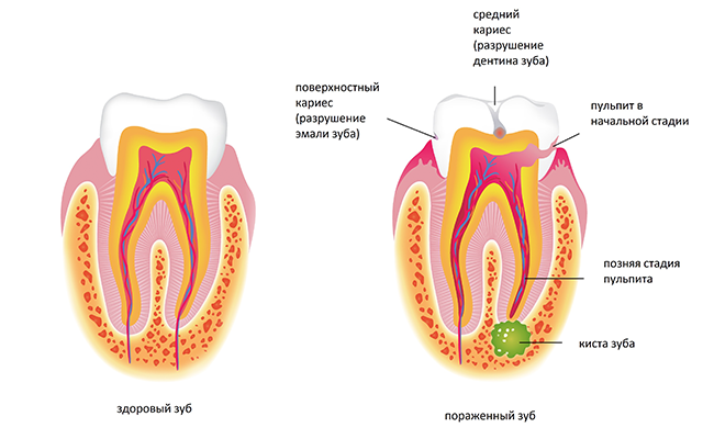 Киста зуба 🚩 что это, лечение, симптомы, признаки