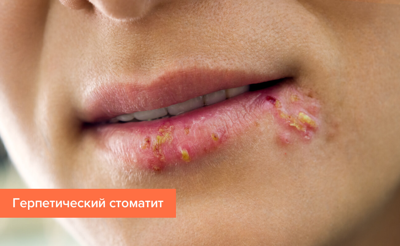 Лечение стоматита грудничков - БЛОГ стоматологии УткинЗуб в Мск
