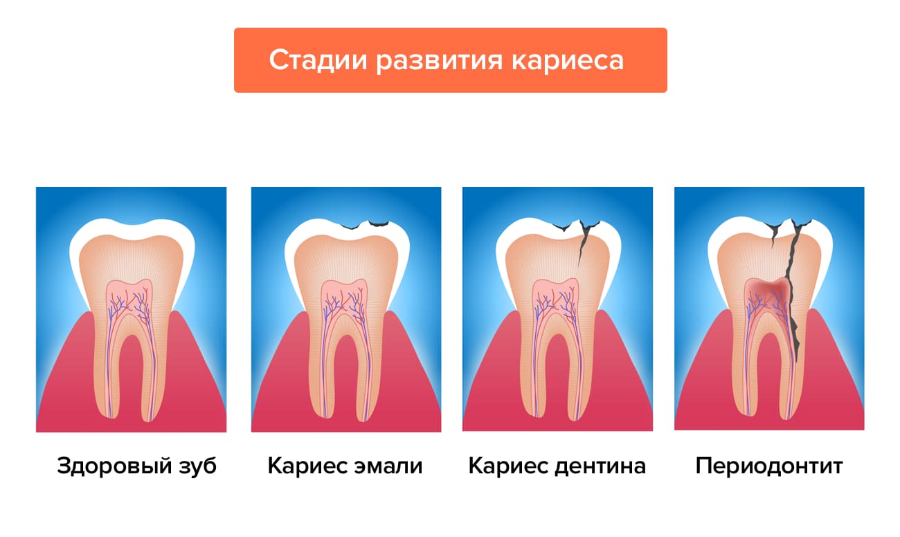 какое лекарство кладут в зуб при периодонтите