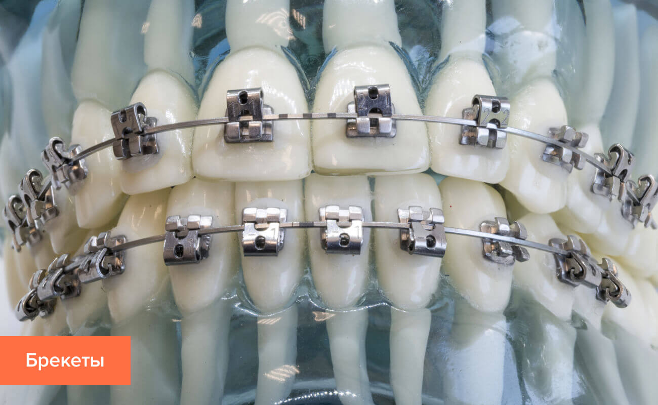 Как выровнять зубы без брекетов: подробный обзор альтернативных методов