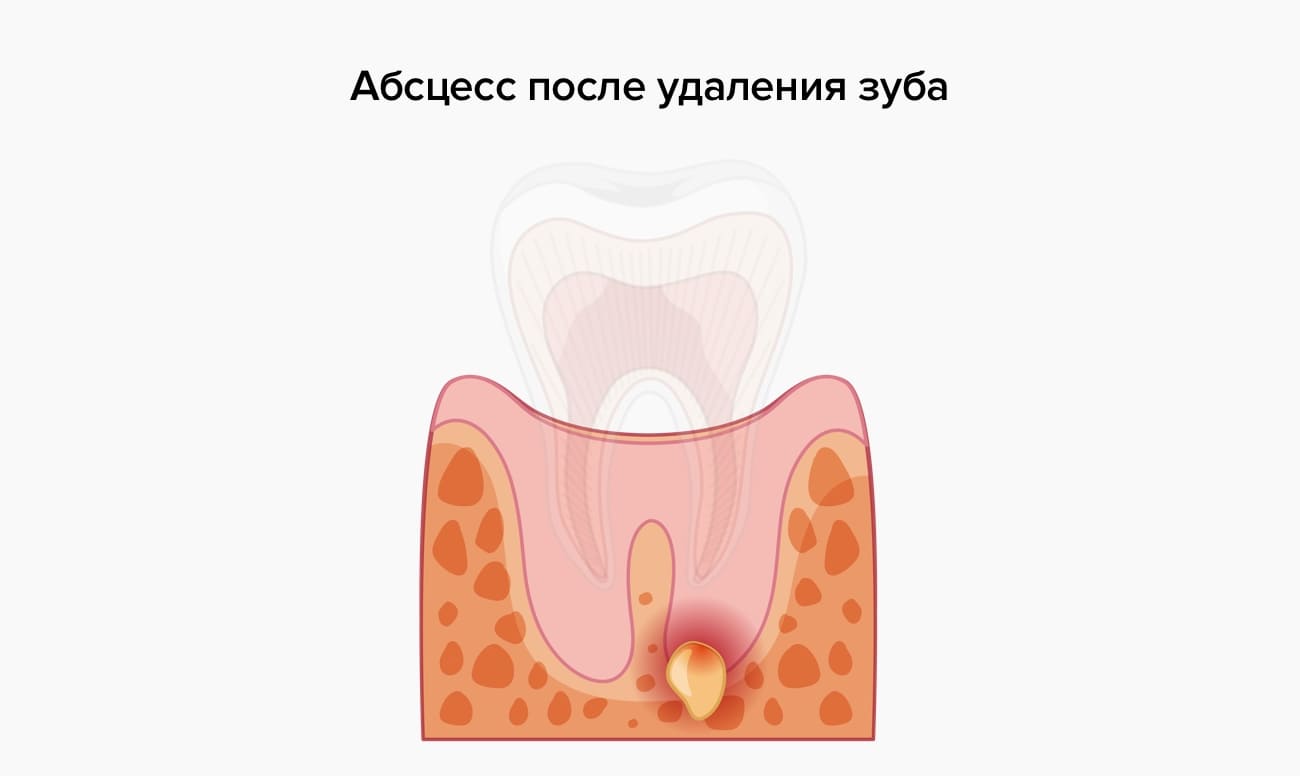 Высокая температура после удаления зуба: в каких случаях это нормально?