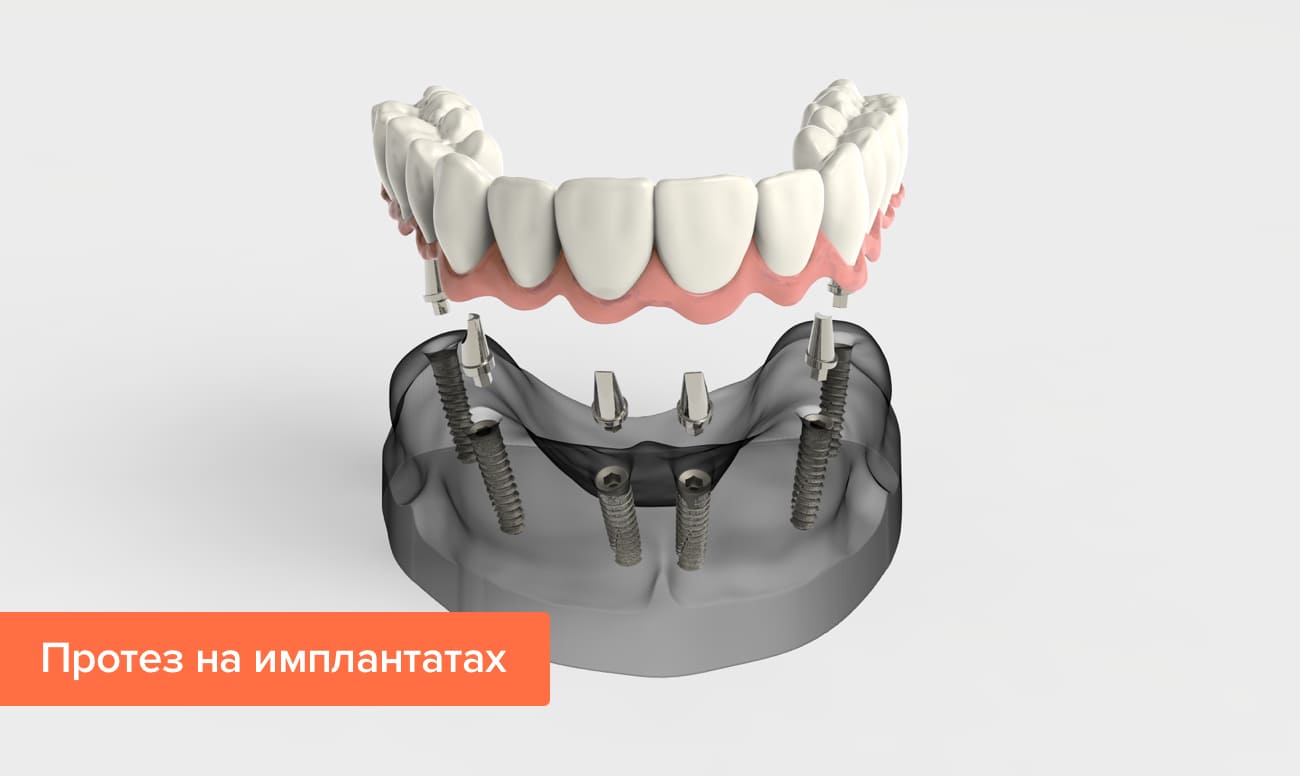 Протез на имплантатах