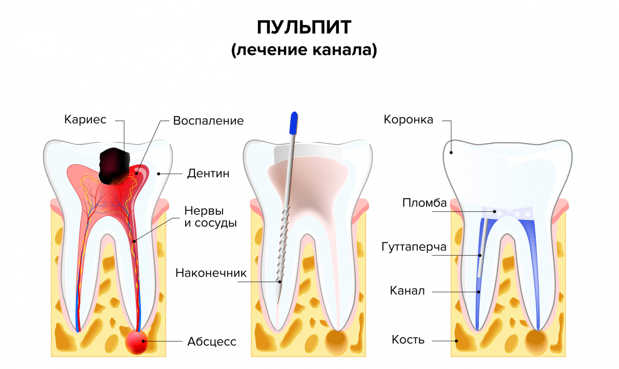 Боль в зубе после пломбирования каналов