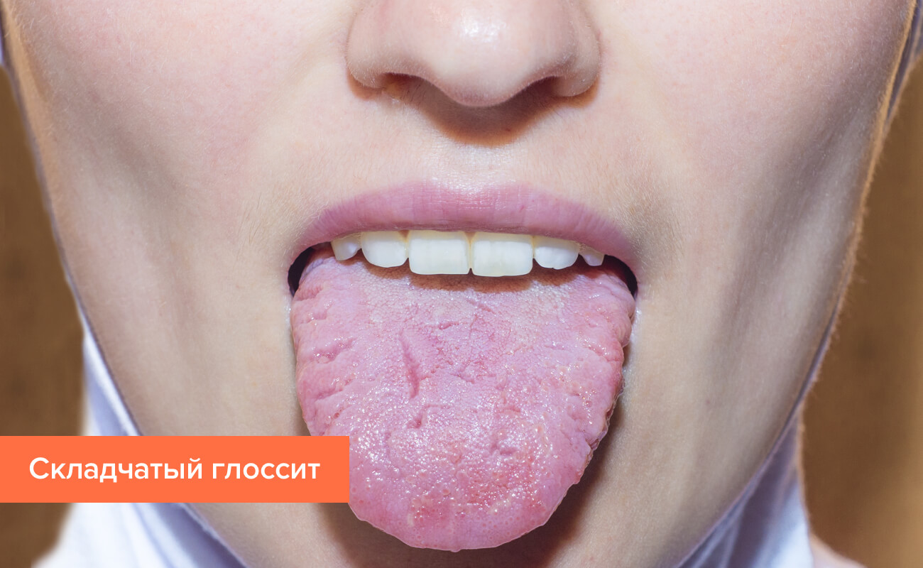 Кандидозный глоссит языка — воспаление, вызванное грибком
