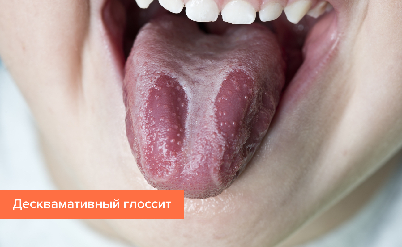 Боль на кончике языка – причины, лечение в клинике Альбадент