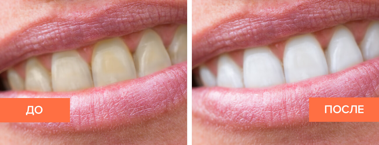 Лазерное отбеливание зубов фото до и после