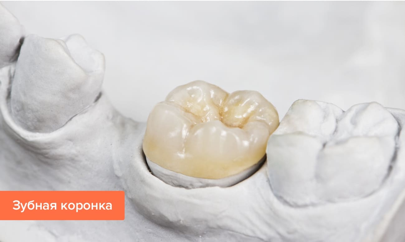 Временный цемент для фиксации коронок — FDC Французская стоматологическая клиника