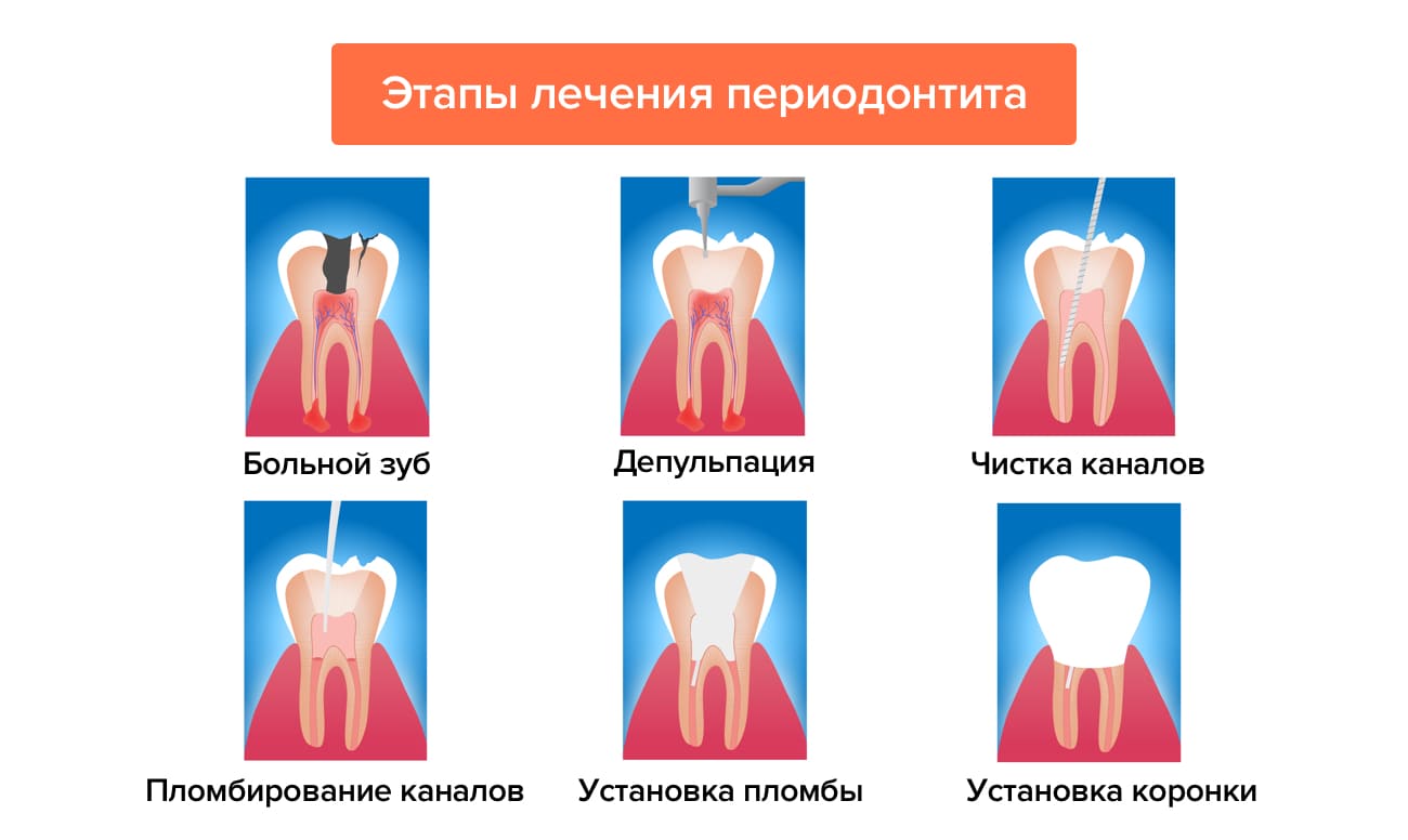 какое лекарство кладут в зуб при периодонтите