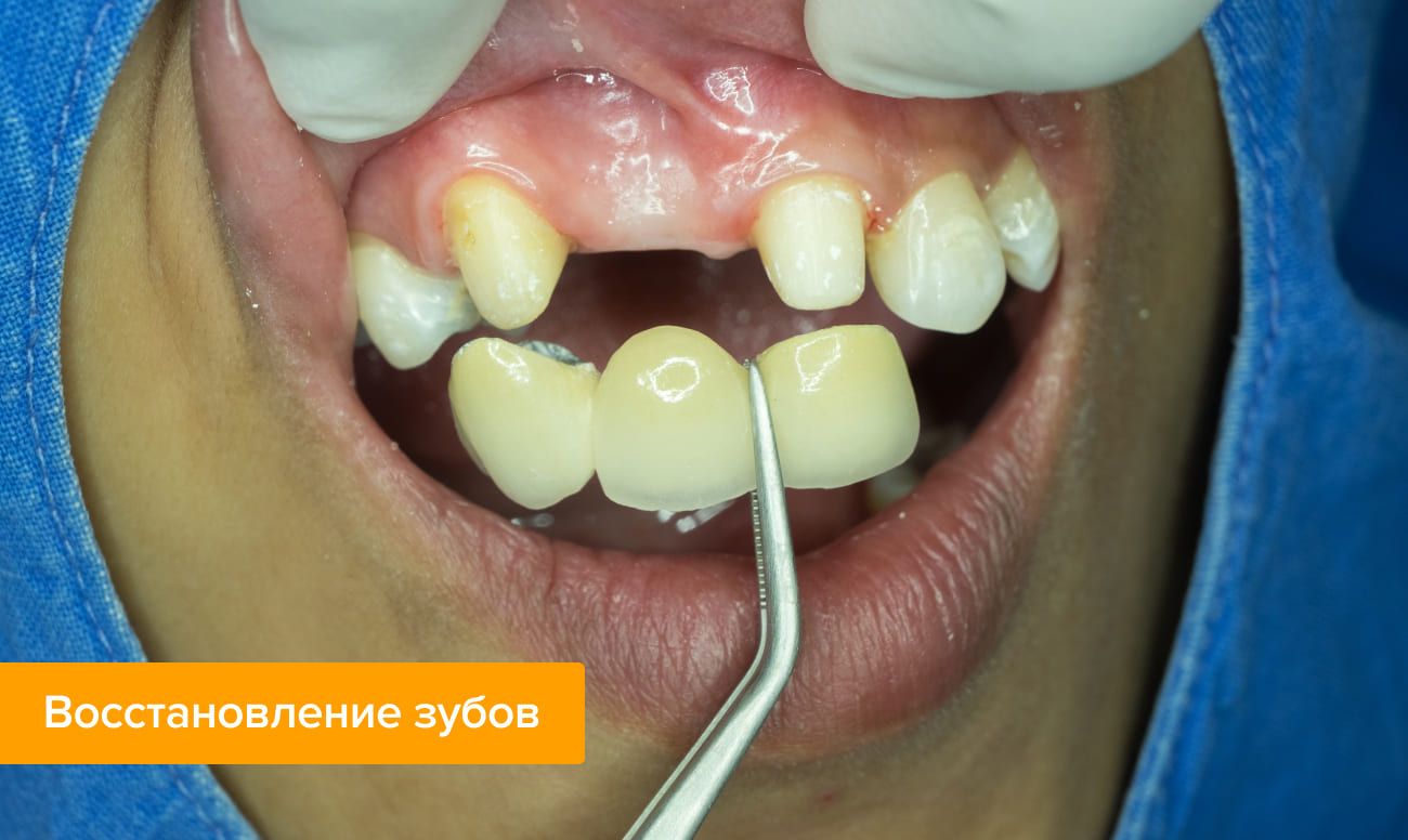 Протезирование при отсутствии большого количества зубов