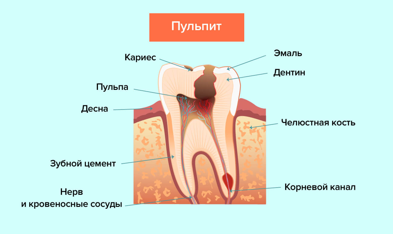 Лечение пульпита зуба: вся самая важная информация