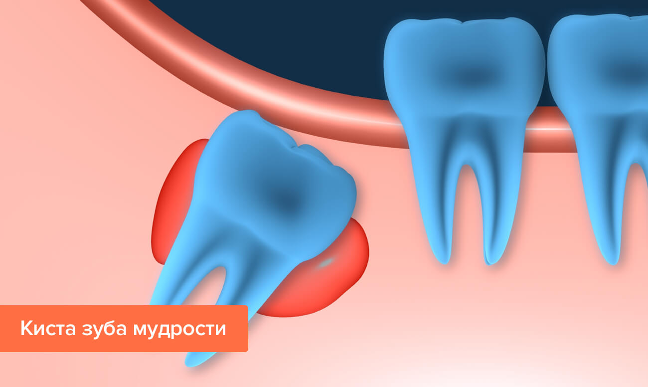 Корневая киста зуба