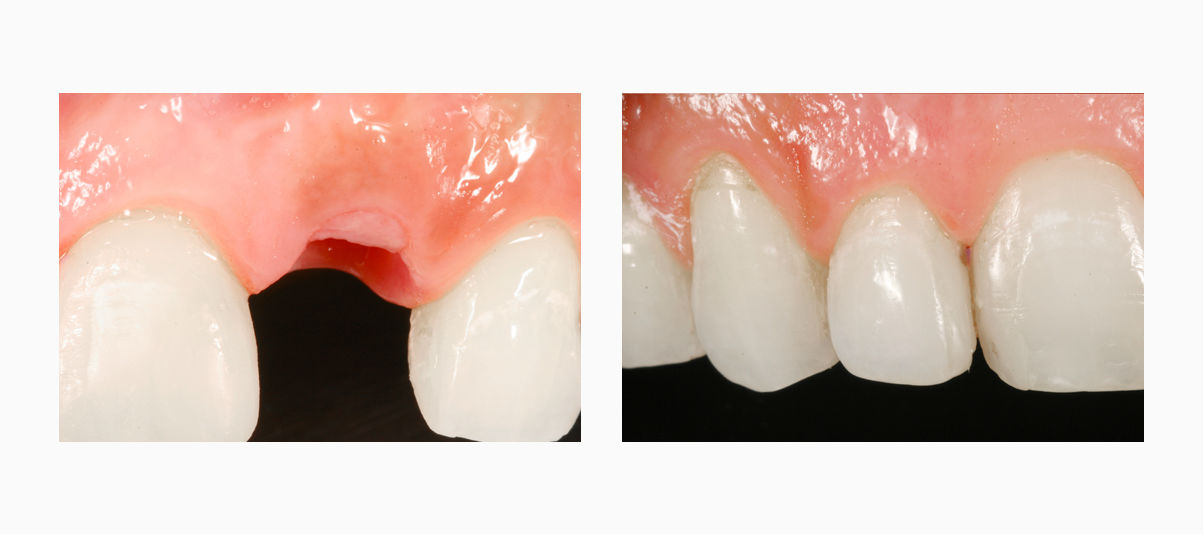 Имплант зуба фото до и после