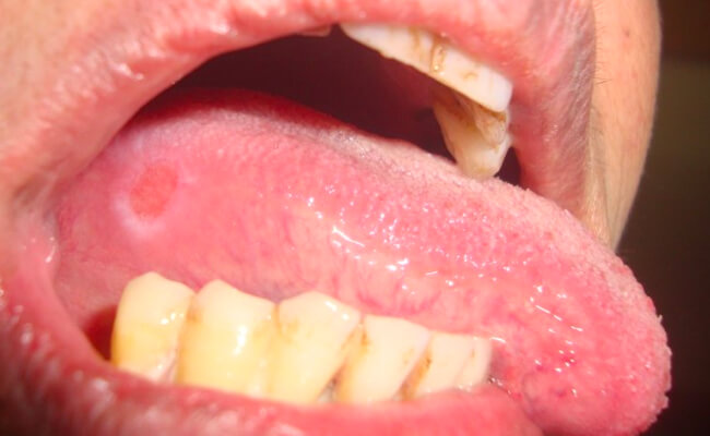 Наиболее частые симптомы рака языка